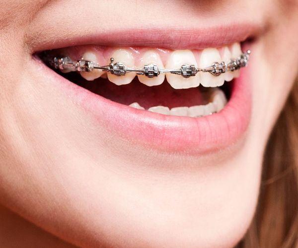 niềng 1 hàm có hiệu quả không